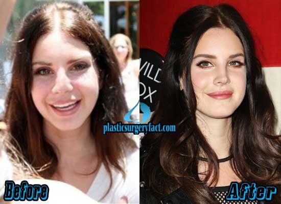 Lana-Del-Rey-Nose-Job-Before-and-After.j